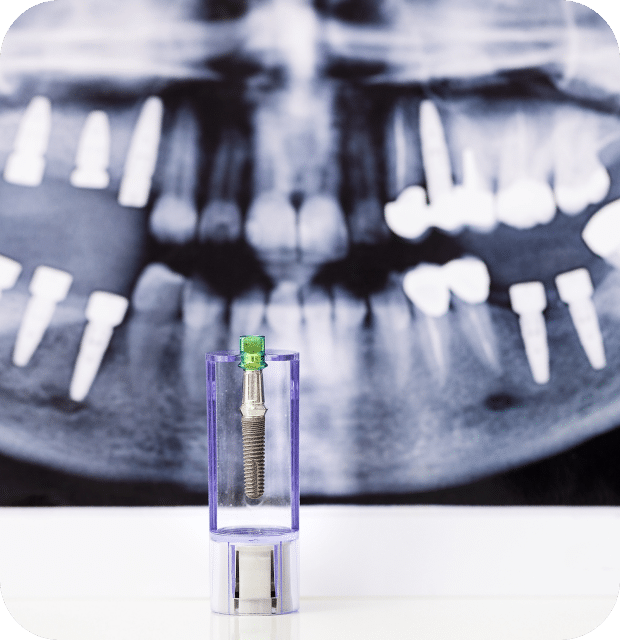 A dental implant displayed in front of a dental X-ray, illustrating its placement and surrounding structures.