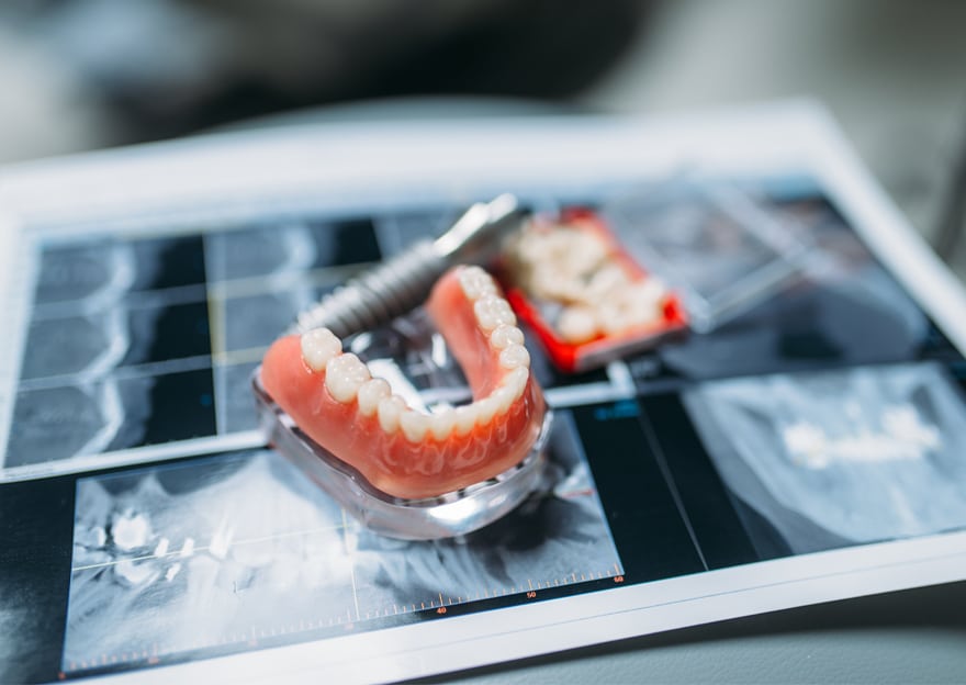 A dental implant and a toothbrush placed on a table, highlighting dental care and oral hygiene.